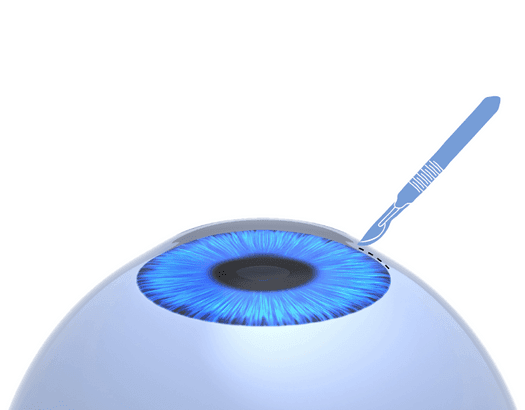 Step 2 of Visian ICL Treatment at Panoram Lasik